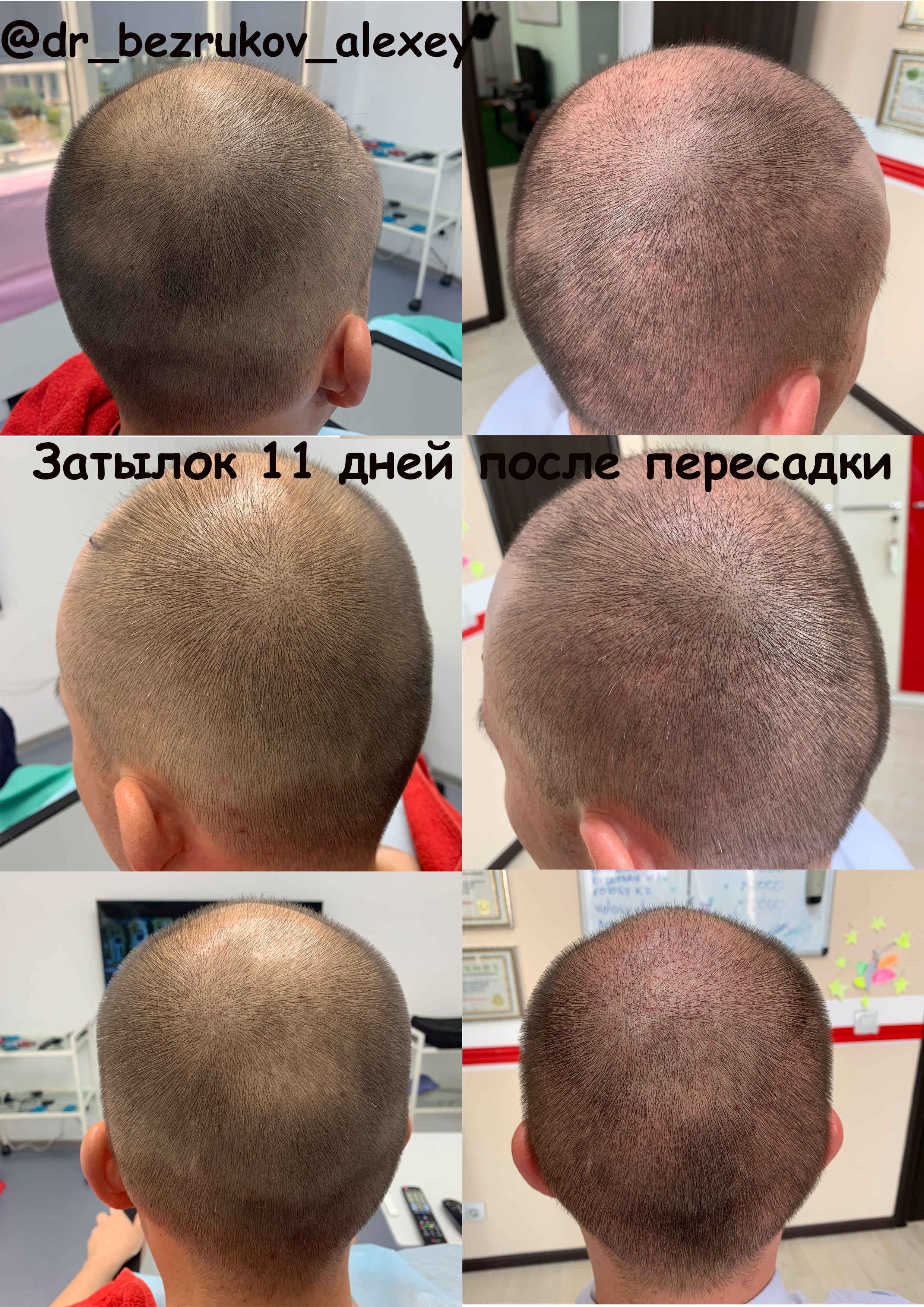 Донорская зона после пересадки. Трансплантация волос с затылка. До и после пересадки волос.