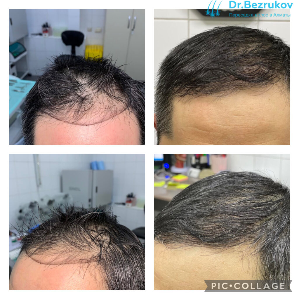 Донорская зона после пересадки. Трансплантация волос до и после.