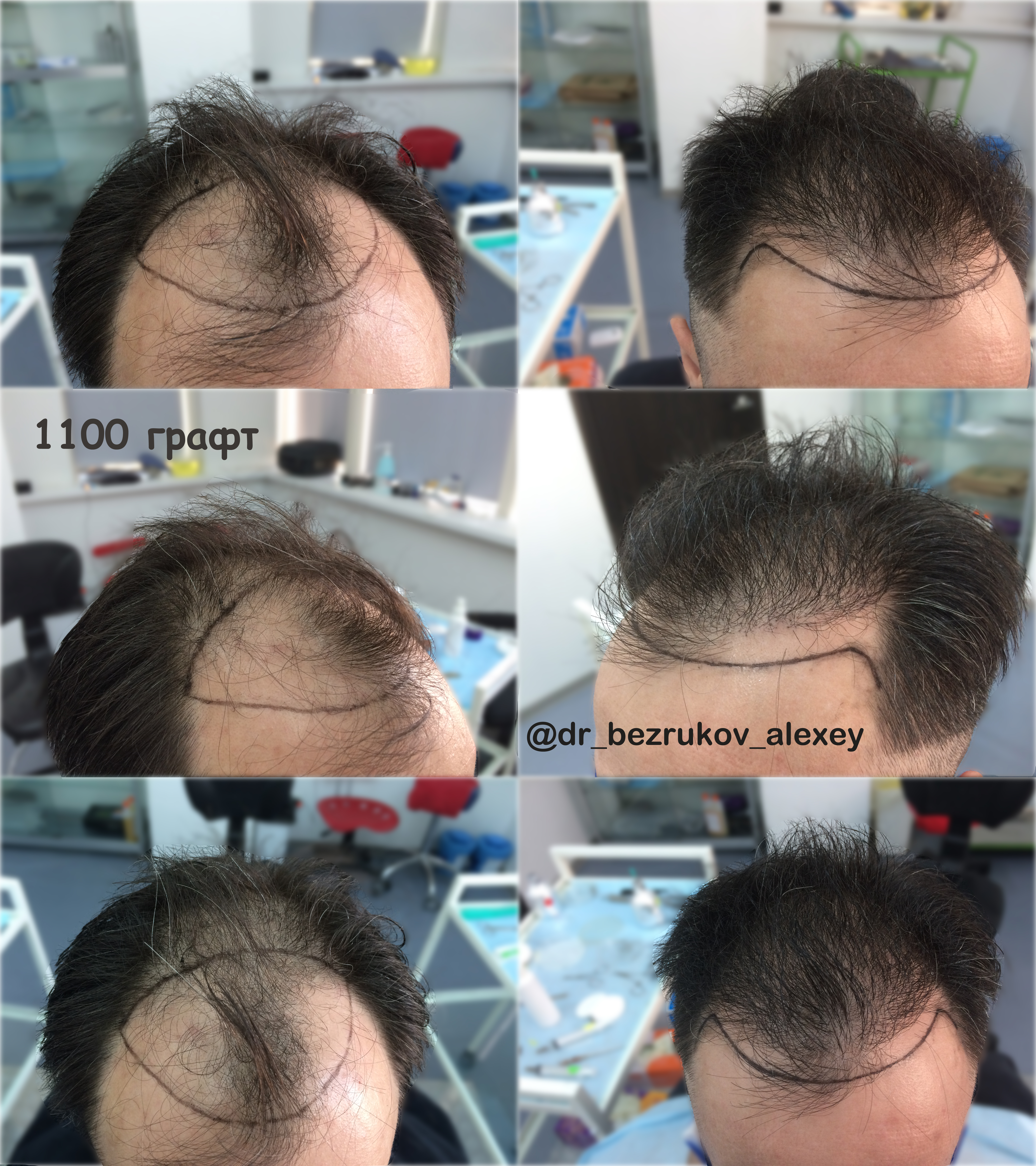 Пересадка графта. Графт трансплантация волос. Пересадка волос графтов. До и после пересадки волос.