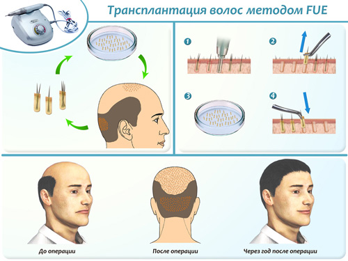 Трансплантация волос методом FUE